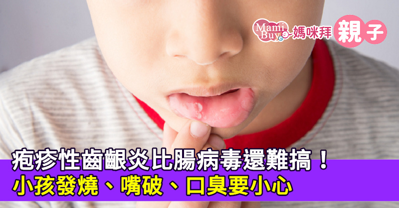 疱疹性齒齦炎比腸病毒還難搞！小孩發燒、嘴破、口臭要小心