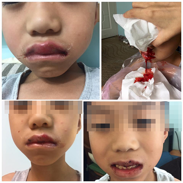疱疹性齒齦炎